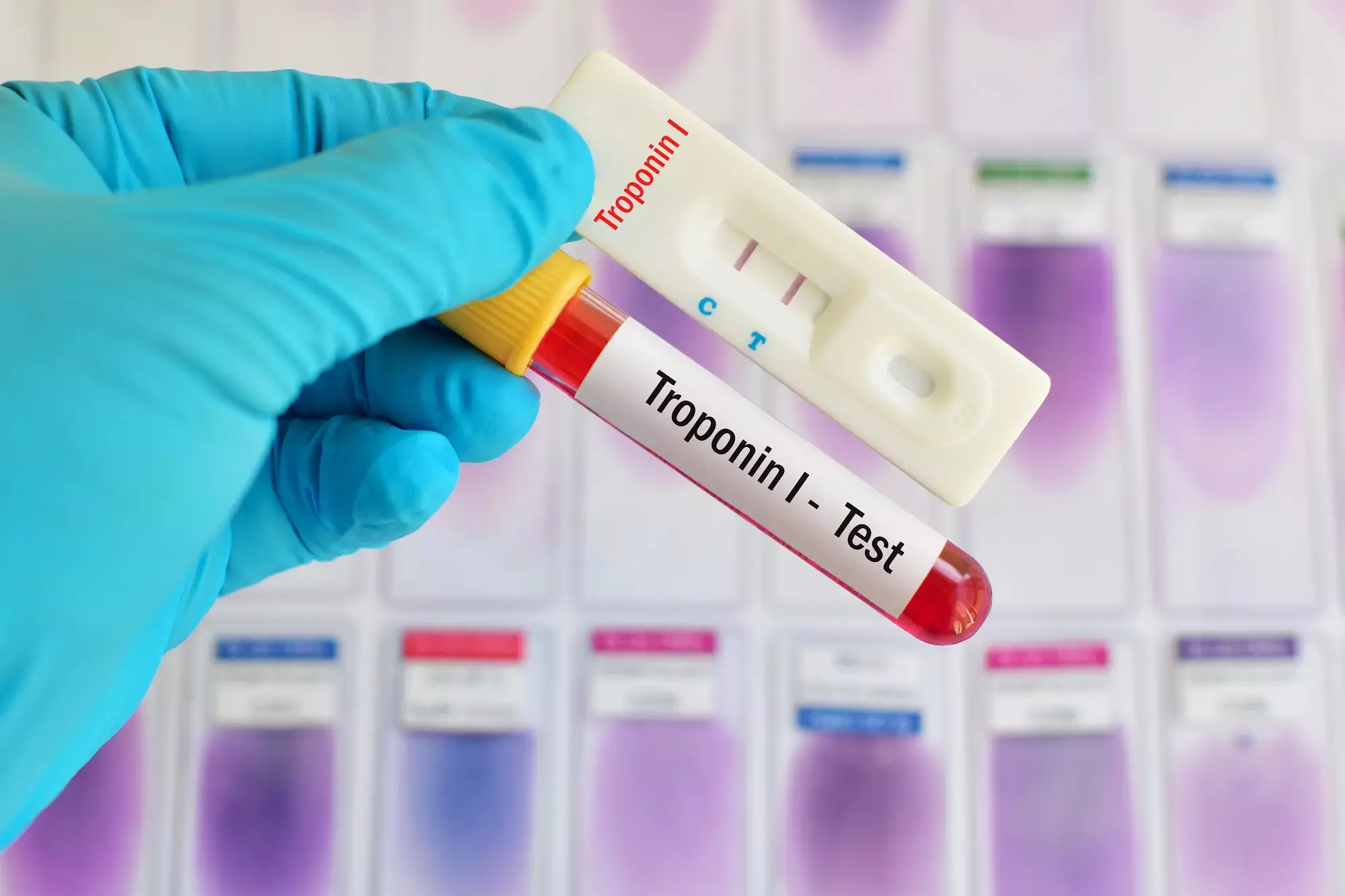 High-sensitivity Troponin assays Raise False Alarm In Kidney Impaired Patients