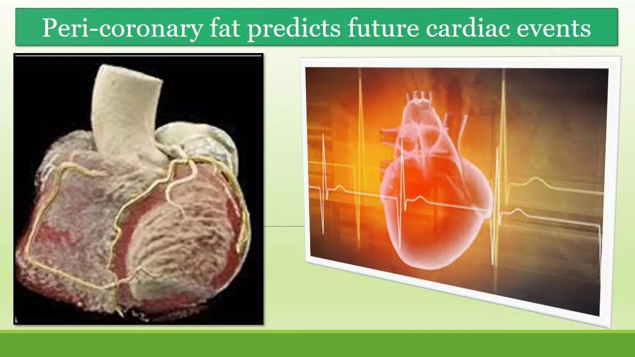 Peri-coronary fat may be a game-changer in cardiovascular risk prediction: JACC study