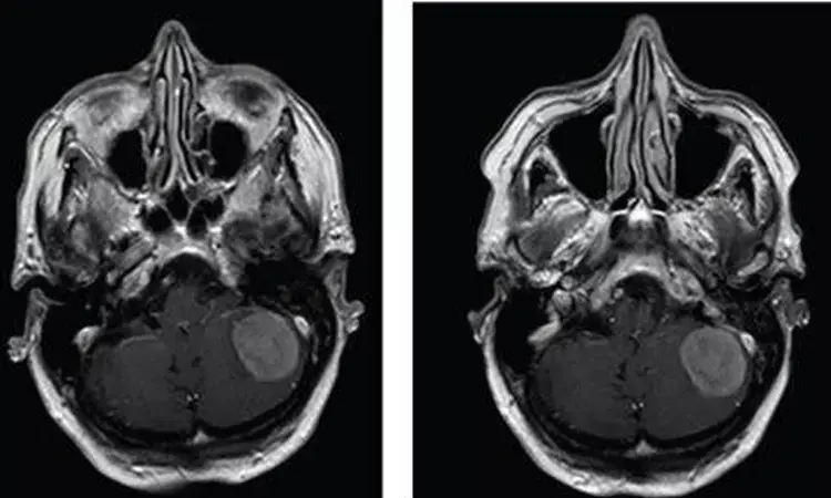 Reduced-dose gadobutrol should be considered for contrast-enhanced brain MRI: Study