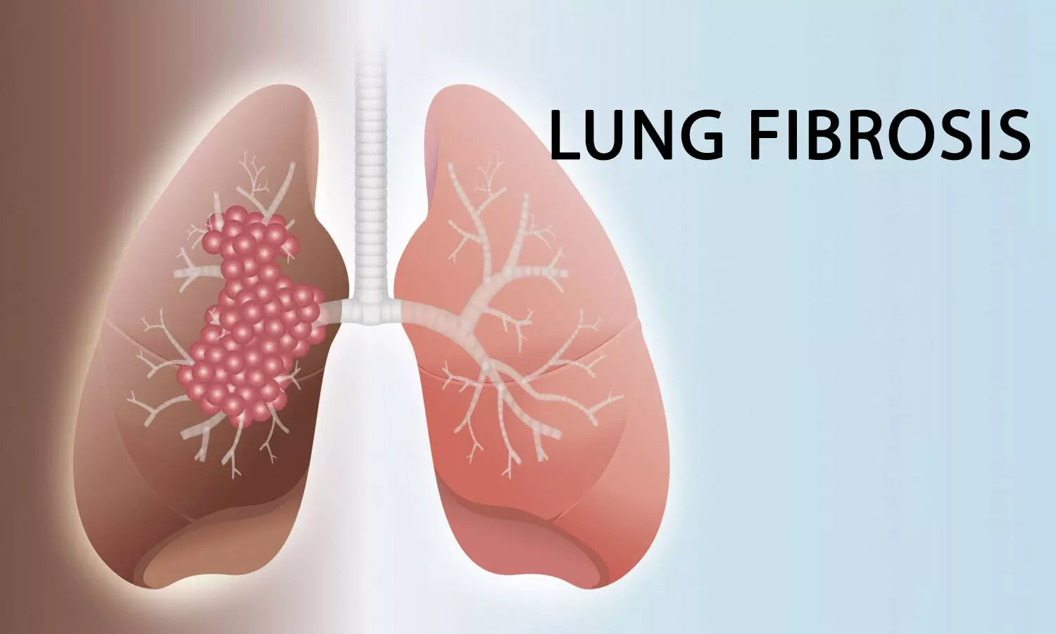 Lung fibrosis of Pulmonary Fibrosis: