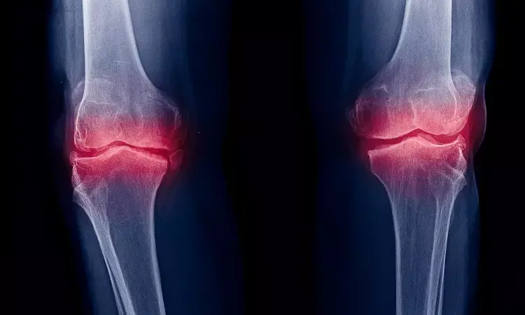 Opioids Cause Joint Degeneration & Progression of Knee Osteoarthritis: Study