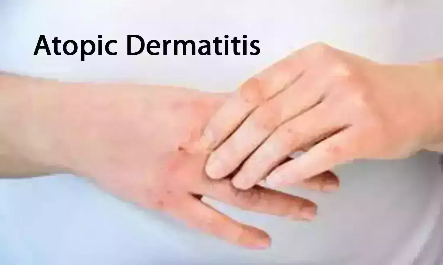 Atopic Dermatitis linked to increased incidence of hypertension: Study