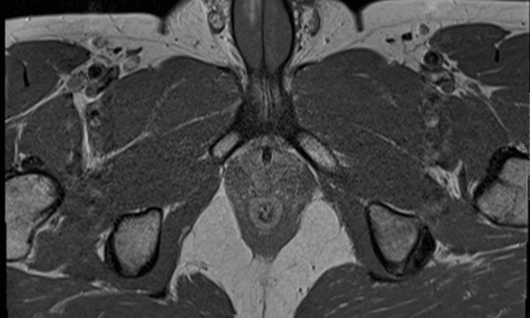 First Ever Recorded Case of Vertical Penile Fracture: BMJ