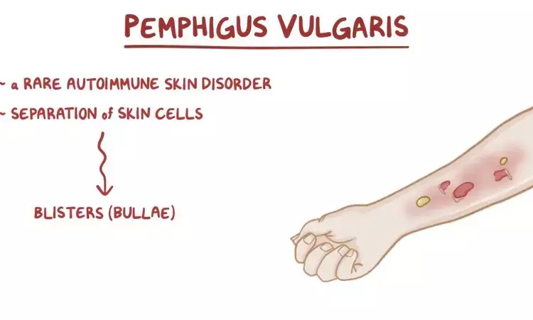 Rituximab superior to Mycophenolate mofetil for complete remission of Pemphigus Vulgaris: Study