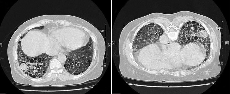 rare-case-of-bilateral-fungus-ball-in-lungs-of-a-covid-positive-male-japi