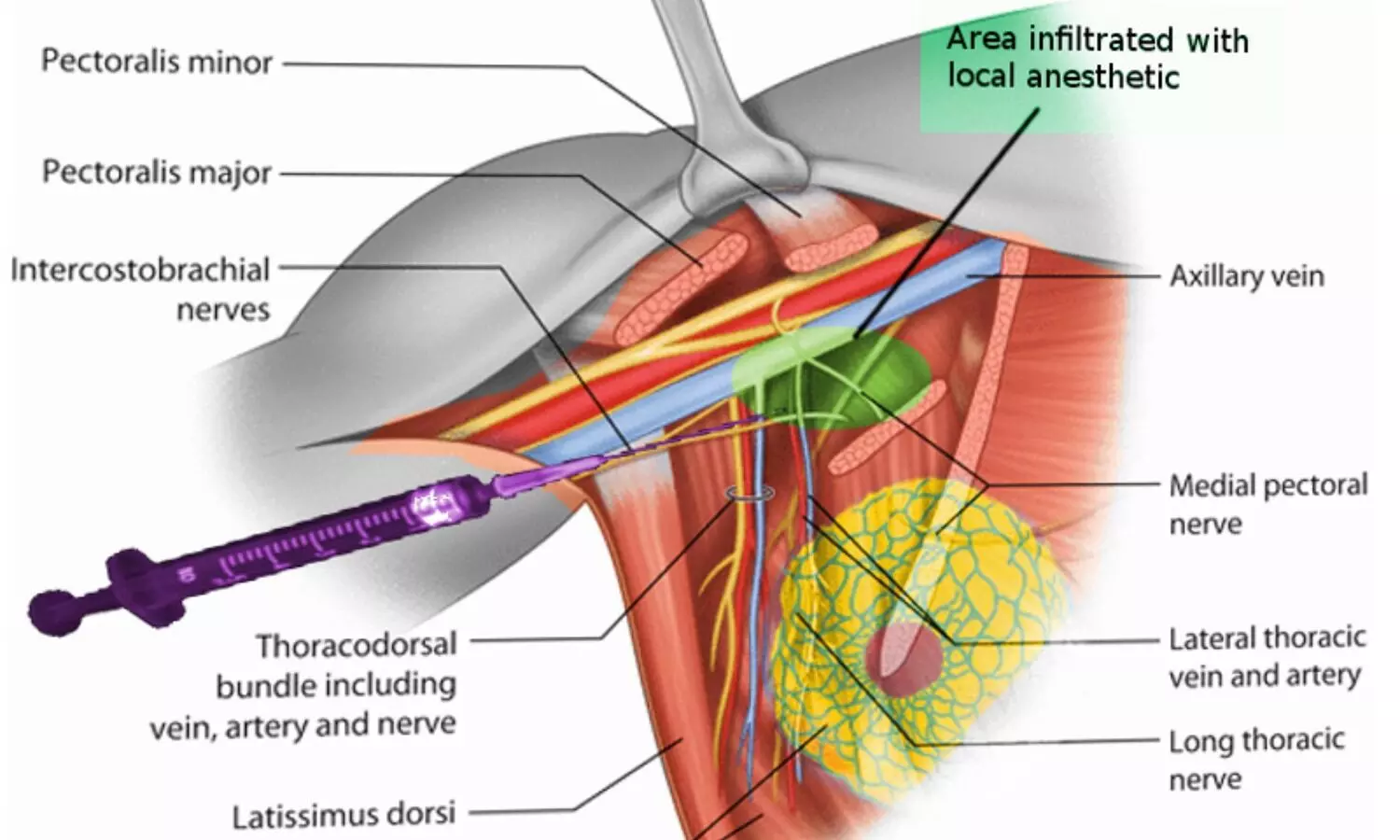 Анатомия хирургия. Pectoralis нерв. Pectoralis Block. N.pectoralis medialis.