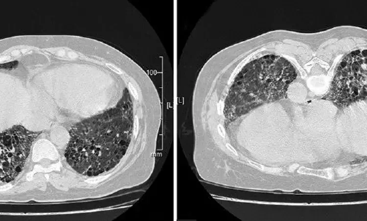 Rare case of bilateral fungus ball in lungs of a Covid positive male:JAPI
