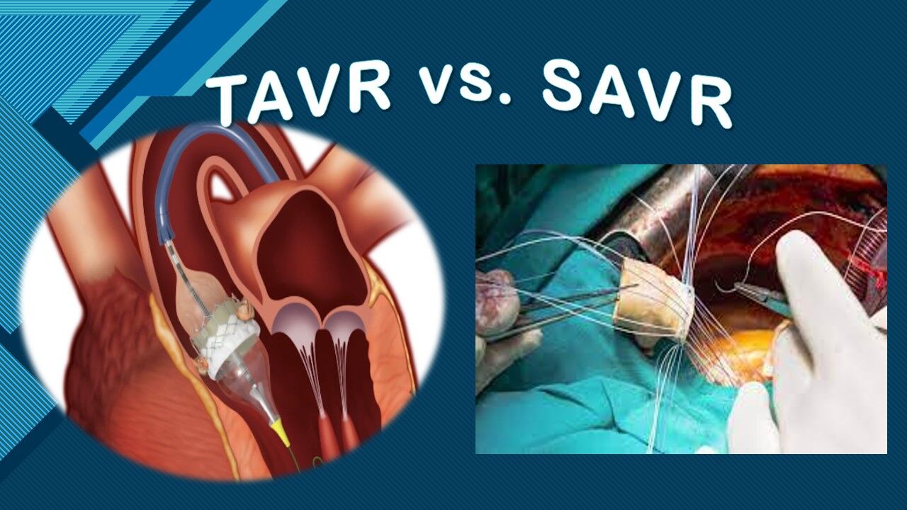 NOTION verdict out TAVR comparable to SAVR even after 8 years, EHJ