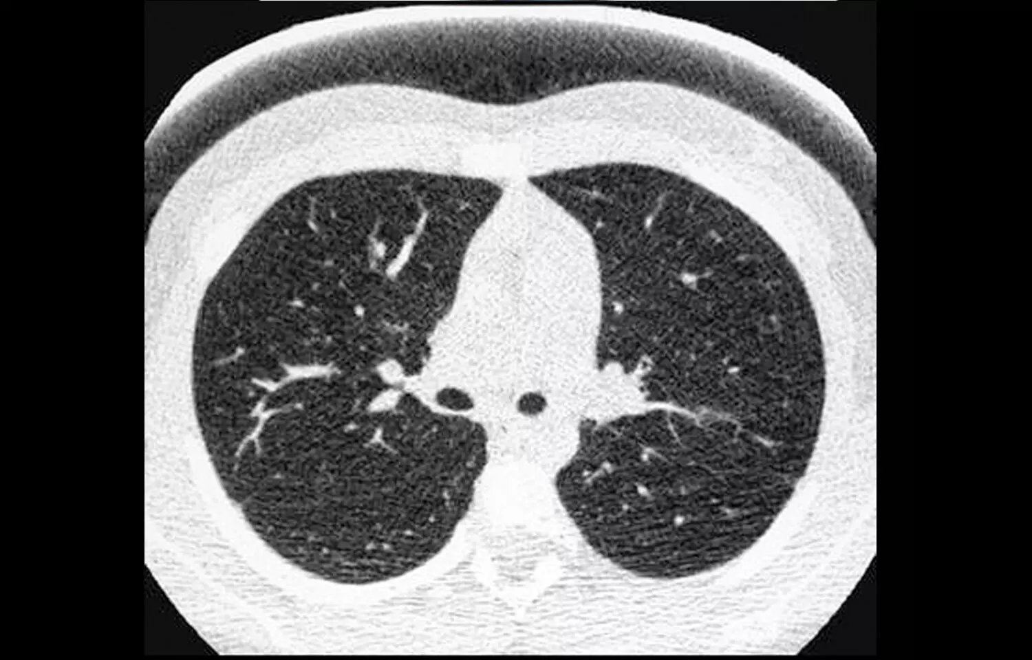 Reduced-dose CT effectively detects lung nodule in kids and young adults with cancer: Study
