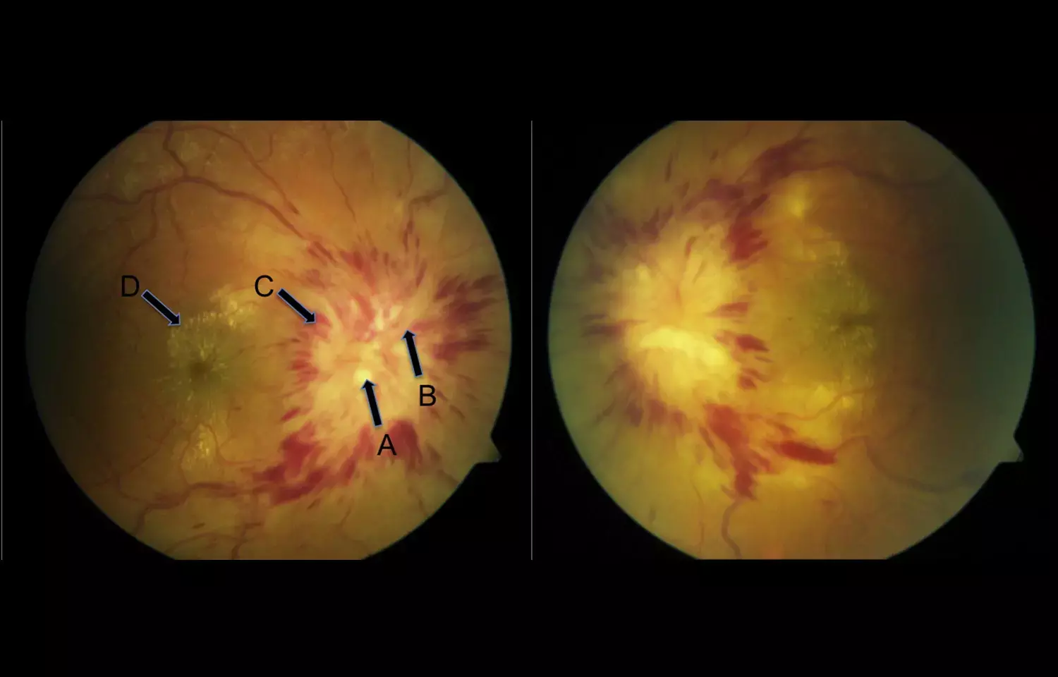 Rare Case of Subacute Vision Loss following development of Rash reported by JAMA