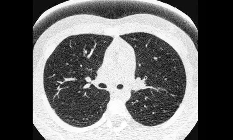 Reduced-dose CT effectively detects lung nodule in kids and young adults with cancer: Study
