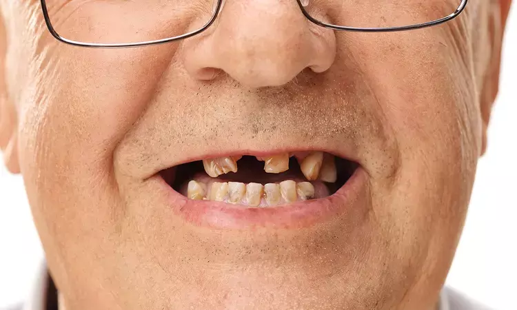 Tooth loss linked to increased risk of dementia, cognitive decline in elderly: Study