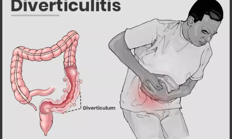 Non-Antibiotic Outpatient Treatment effective for Mild Acute Diverticulitis: Study