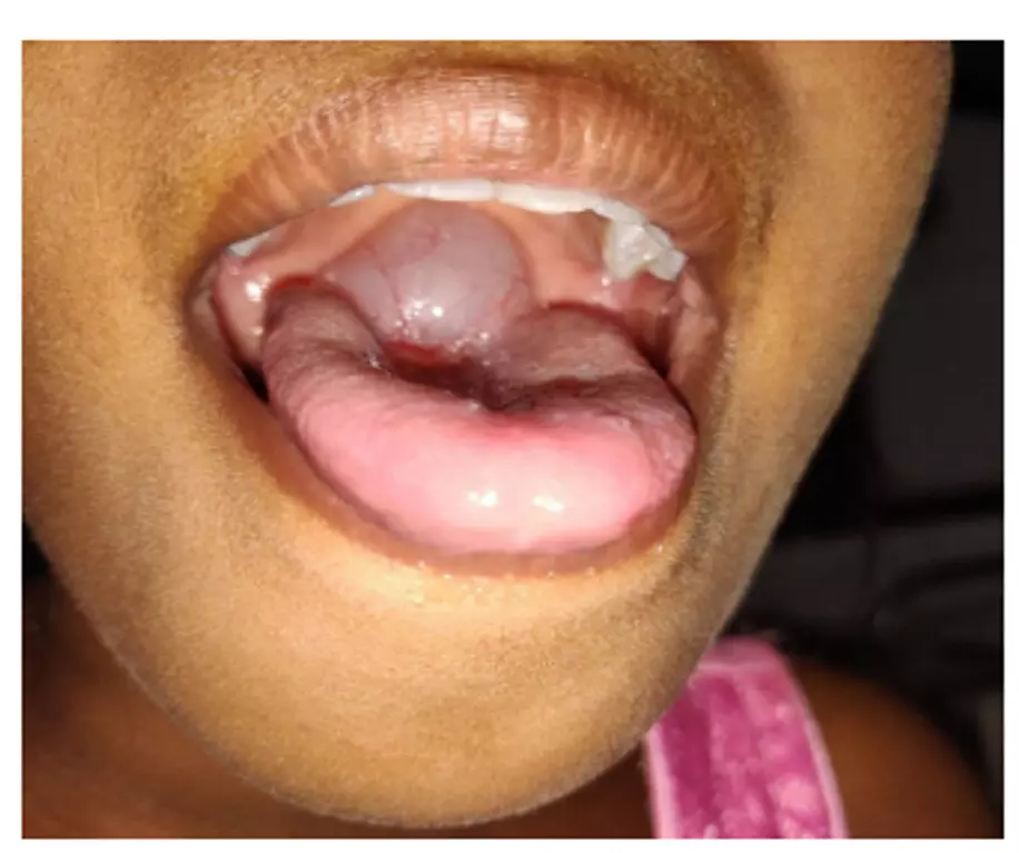 A rare case of giant vallecular cyst with impending respiratory failure: BMJ case report