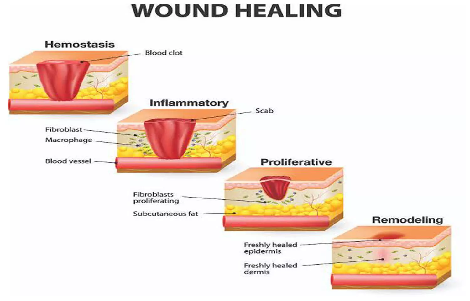 A New Inexpensive Way To Heal Chronic Wounds