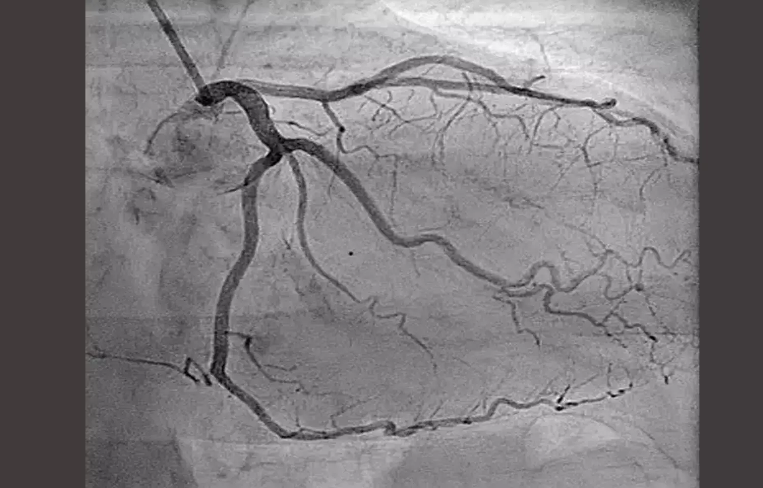 Routine pressure wire assessment of no additional benefit for diagnosing cause of chest pain: Study