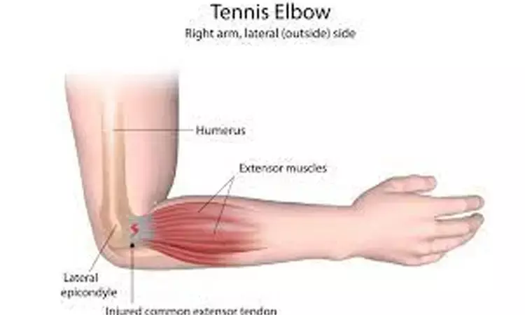 Proprioceptive elbow training reduces pain and improves function in tennis elbow: Study