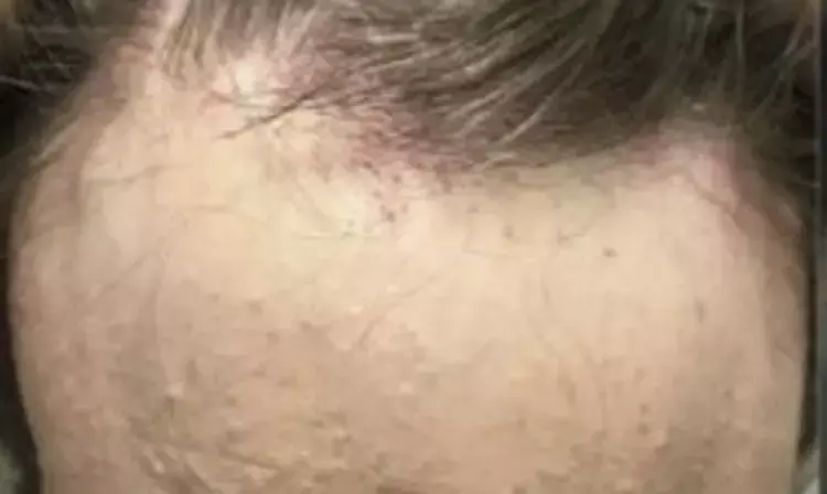Frontal fibrosing alopecia from a clinicians perspective: JAAD