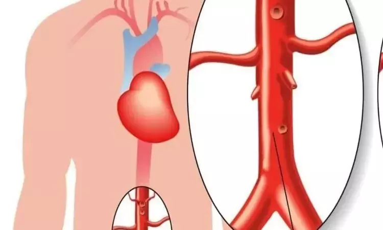 Researchers devise effective prediction model for diagnosing thoracic aorta aneurysms: JAMA