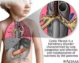 CYSTIC FIBROSIS : Challenges in diagnosis and treatment
