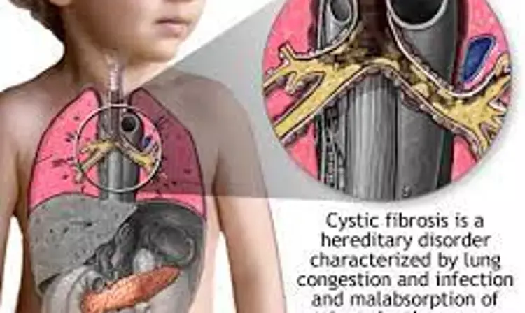 CYSTIC FIBROSIS : Challenges in diagnosis and treatment