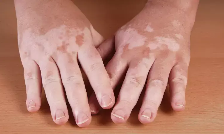 Oral tranexamic acid beneficial for melasma in vitiligo patients: study