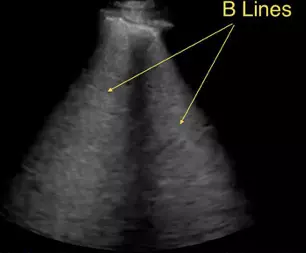 Lung Ultrasound helps achieve faster resolution of congestion in acute heart failure