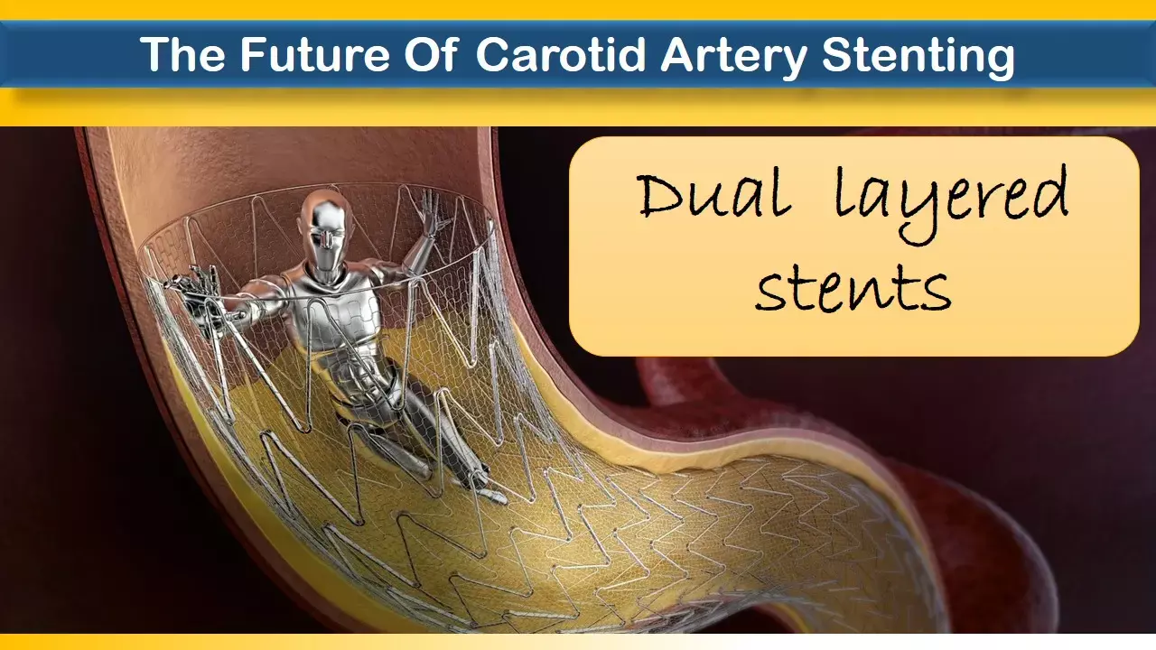 Dual layered stents give excellent outcomes for carotid artery stenting, IRON-GUARD-2 study