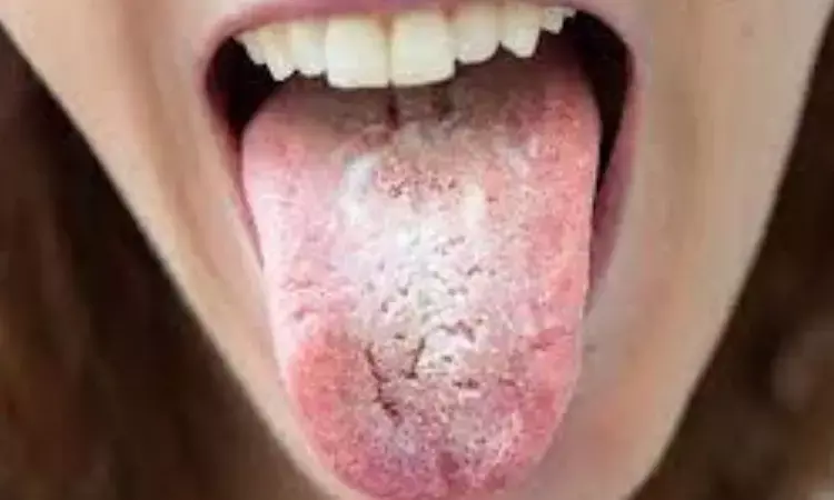 ICPA introduces Wet Mouth - Saliva Substitute For Individuals Suffering From Dry Mouth