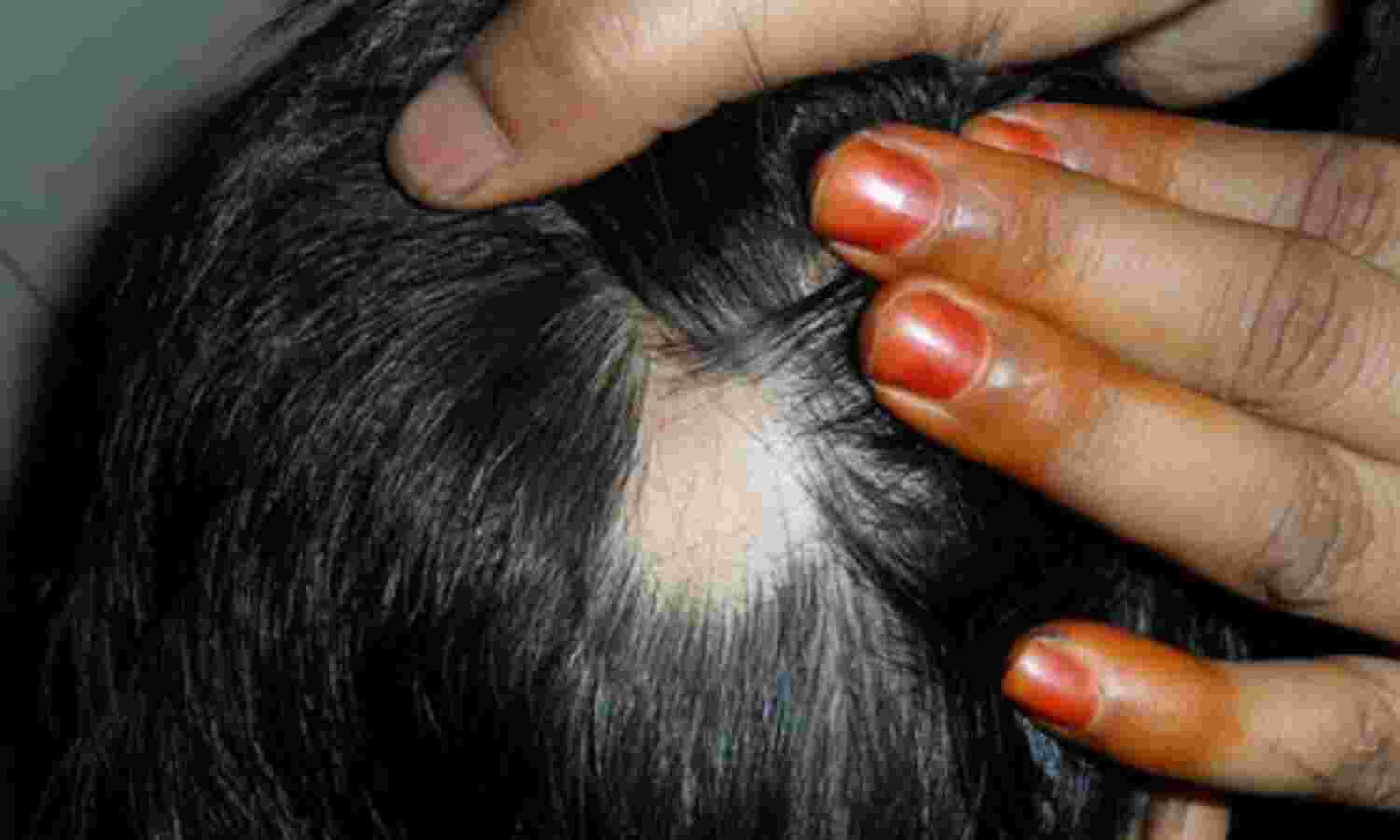 Should You Get Steroid Injection Treatments for Alopecia? – Zang SMP