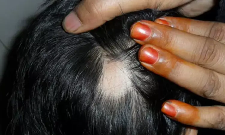 Ritlecitinib and brepocitinib improve scalp alopecia areata biomarkers: Study