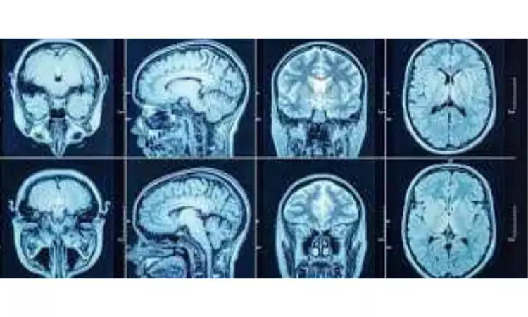 Portable MRI provides life-saving information to doctors treating strokes