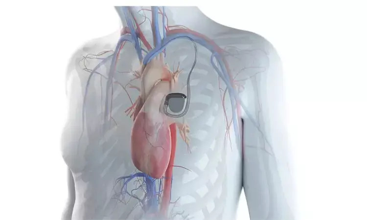 Magnets in latest portable electronic devices interfere with Implantable cardiac devices