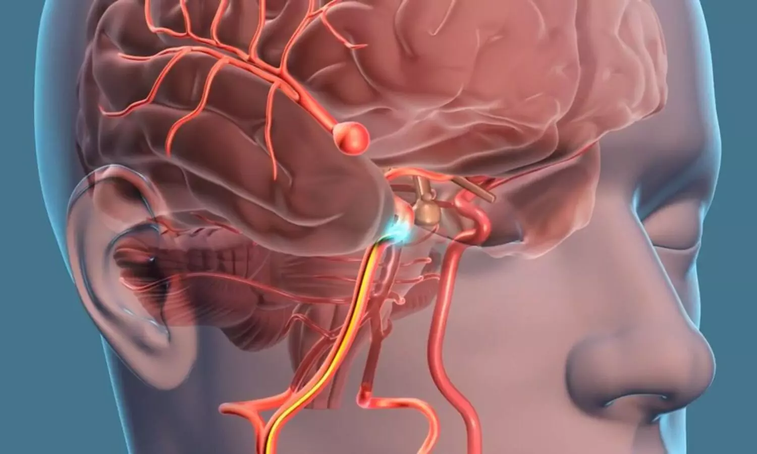 1 out of 25  patients of Intracranial Aneurysm Growth have rupture with in one year: JAMA
