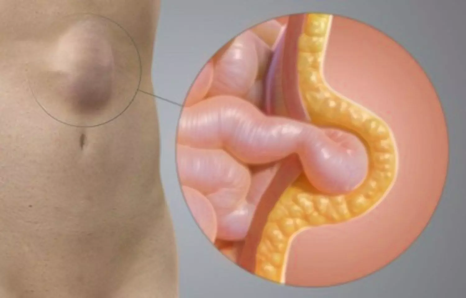 Incidence of incisional hernia high after colorectal surgery independent of suture technique