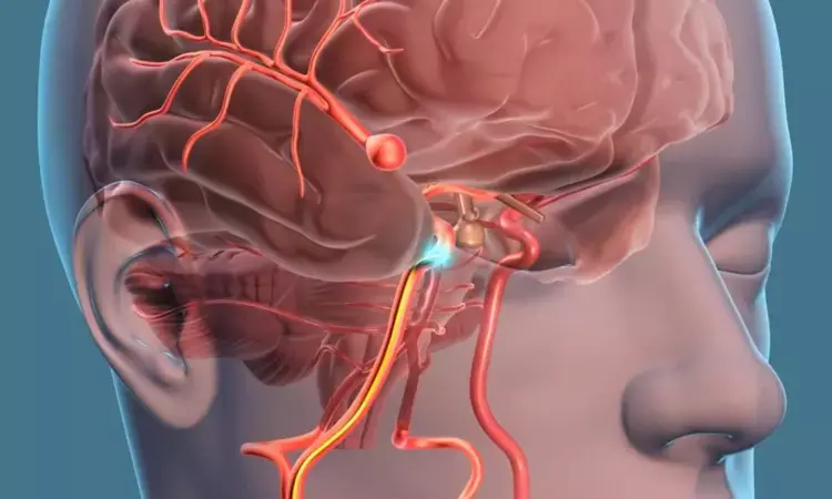 Woven Endobridge  device-  New device for treatment of brain aneurysms