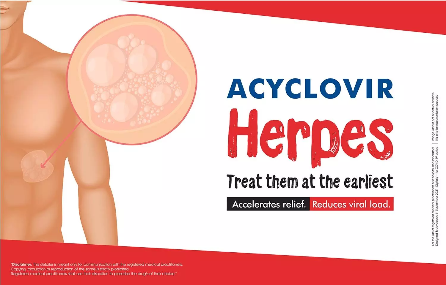 Acyclovir: How it reduces viral load and speeds up healing in herpes lesions