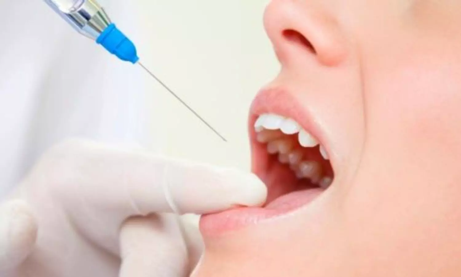 Articaine - a safe and efficacious local anaesthetic for all routine dental procedures: Study