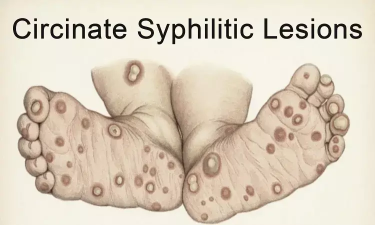 Case of Circinate Syphilitic Lesions reported in NEJM