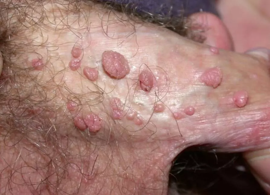 Cryotherapy Effective as First-Line Treatment for Genital Warts: Study Cryotherapy Effective as First-Line Treatment for Genital Warts: Study