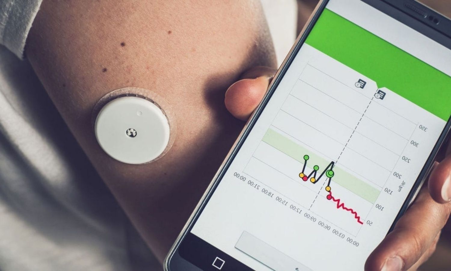 CGM may reveal insights into steroid-induced hyperglycemia: Study