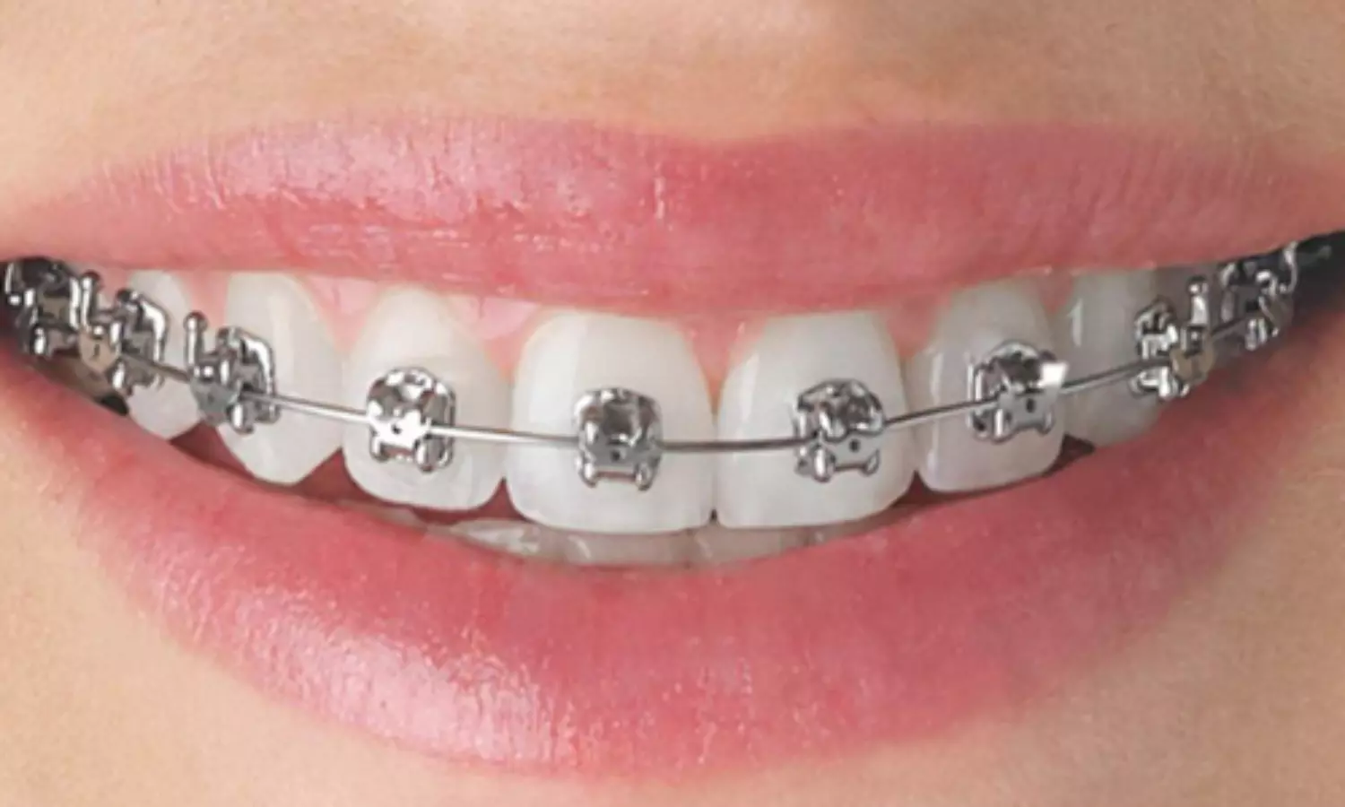 Remote digital monitoring effective in plaque control during orthodontic treatment: Study