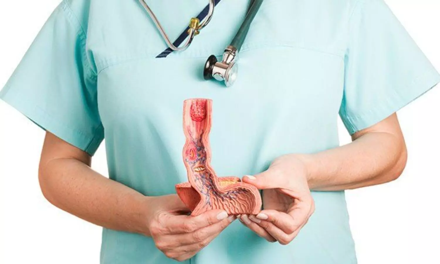 New prediction model helps stratify death risk after esophagectomy for cancer: Study