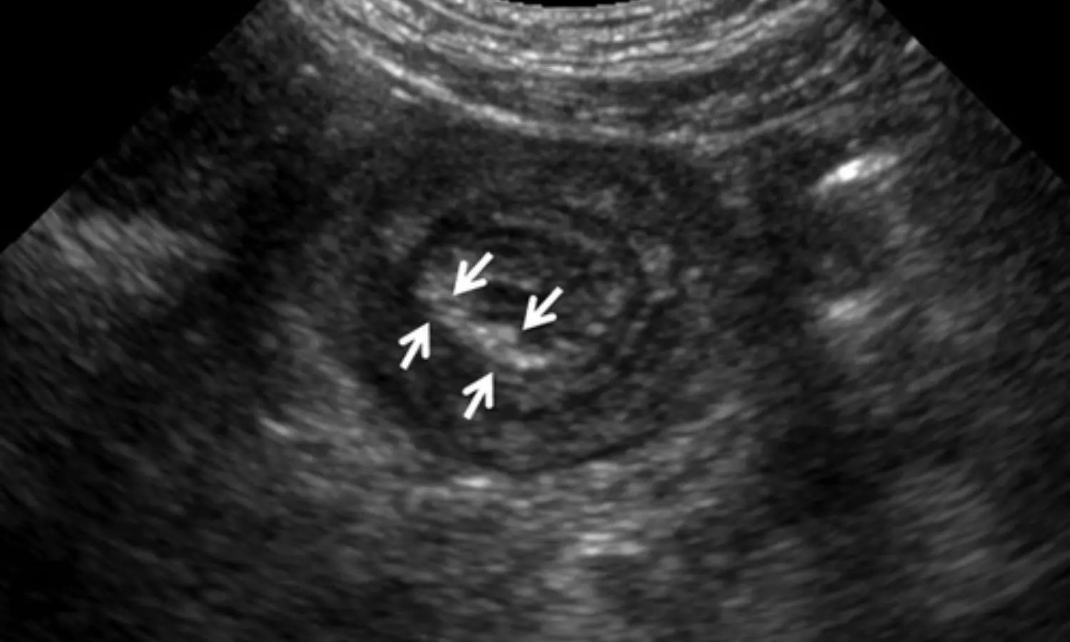 POCUS helpful for differentiating intussusception in pediatric patients: Study