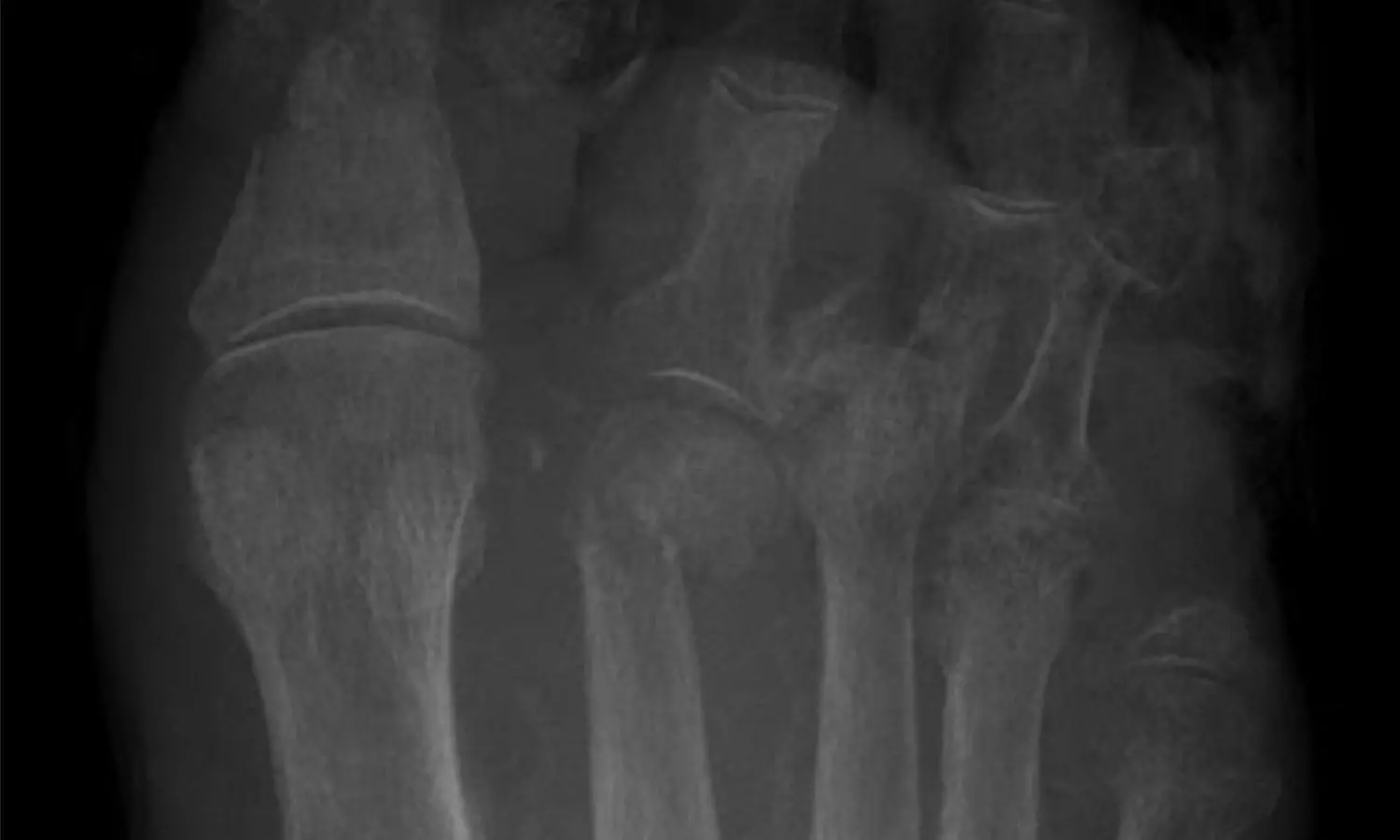Clinical outcomes of Tightrope system in the treatment of purely ligamentous Lisfranc injuries