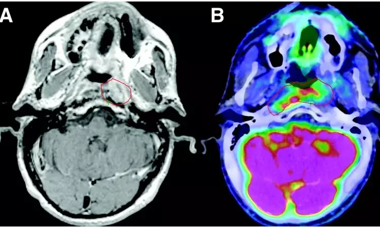 PET imaging aids in better target volume delineation over MRI in meningioma: Study