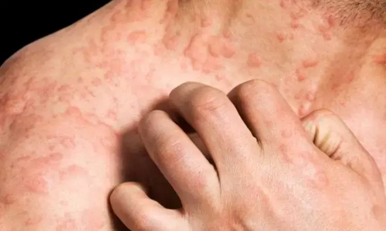 Dupilumab notably reduces hives and hitch in patients with chronic spontaneous urticaria: Study