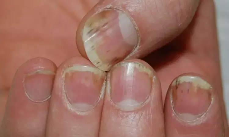 Study gives 'thumbs-up' to nail polish in hospital