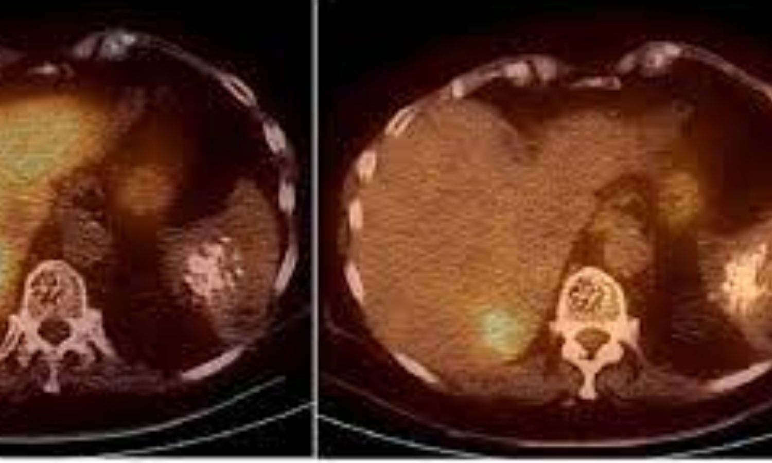 PET/CT predicts early response to TARE treatment in liver cancer ...