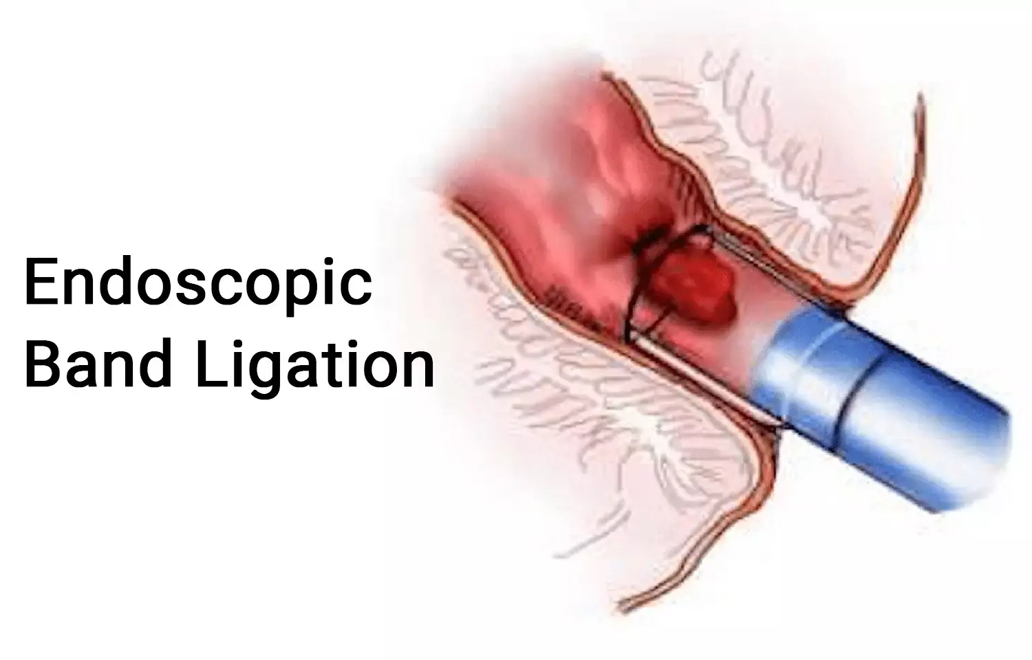 Endoscopic band ligation a better technique to treat Gastric antral vascular Ectasia: Study
